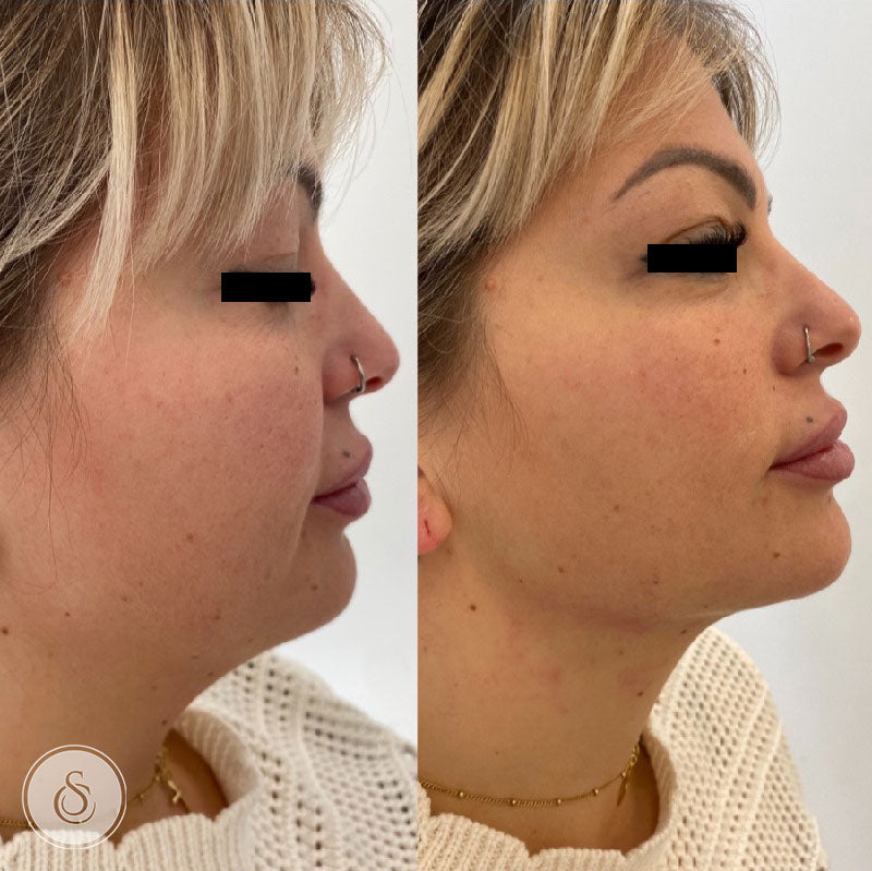 Tratamiento de lifting facial sin cirugía: HIFU 7D en cuello y mandíbula