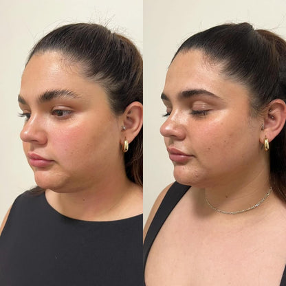 Tratamiento de lifting facial sin cirugía: HIFU 7D en cuello y mandíbula